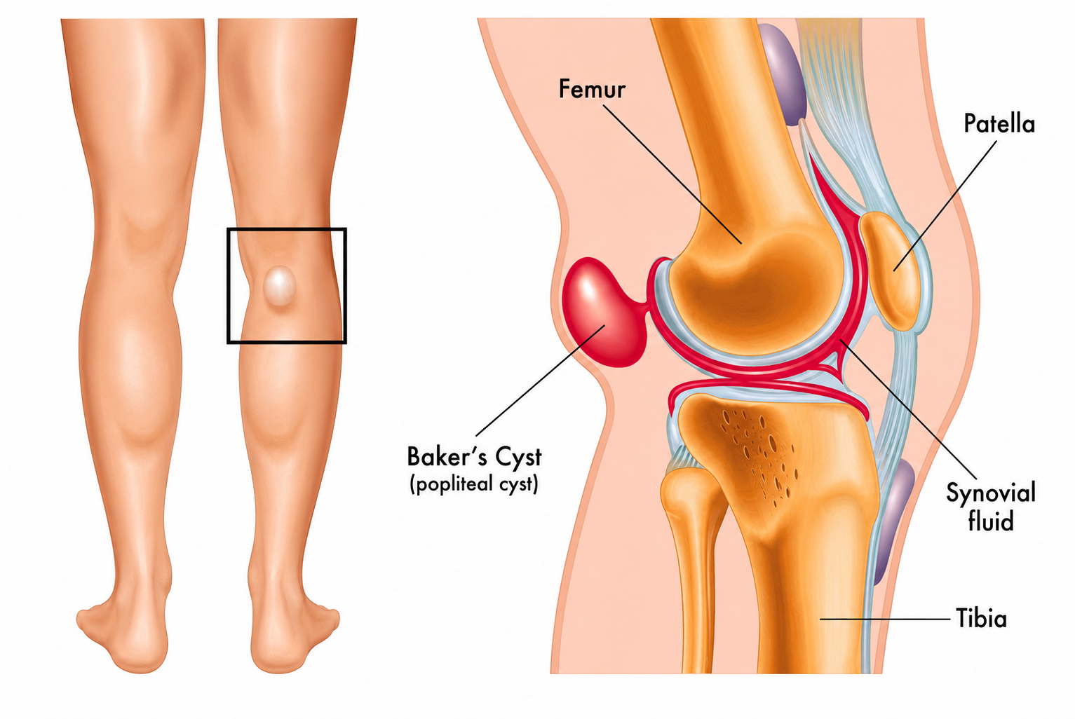 Baker's Cyst Overview